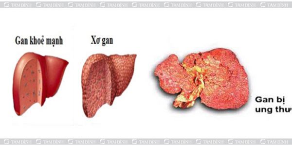 Xơ gan có nguy hiểm không